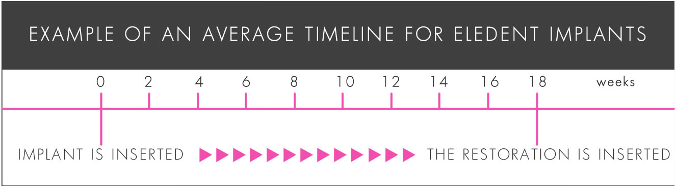 Dental Implants Timeline