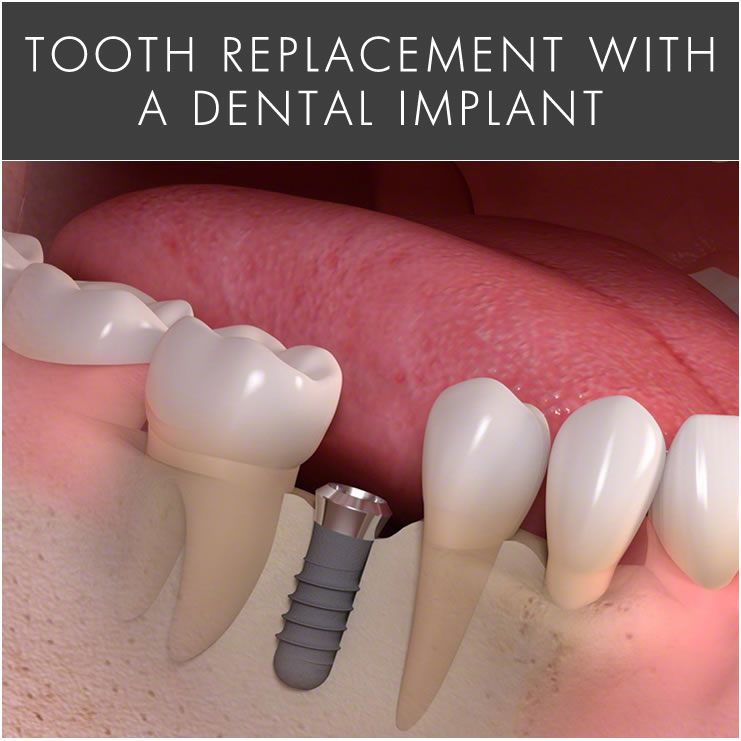 Dental Implants