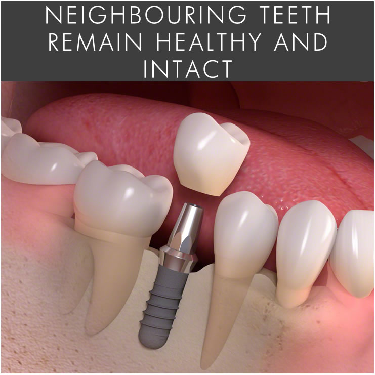 Dental Implants