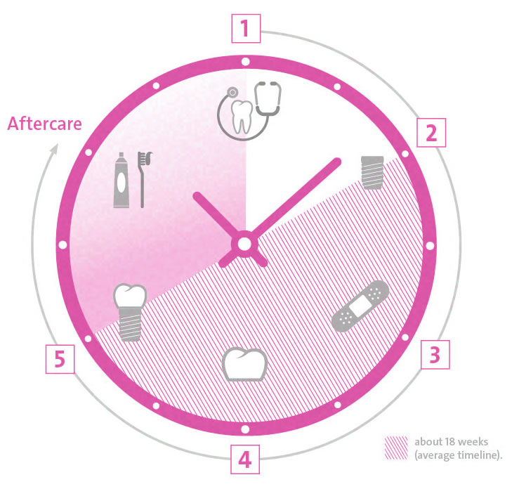 Implants Process