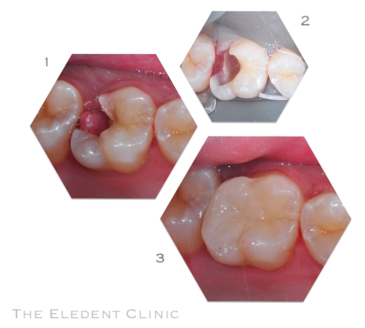 White Fillings
