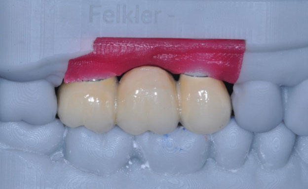 fixed 3 unit Implant supported bridge