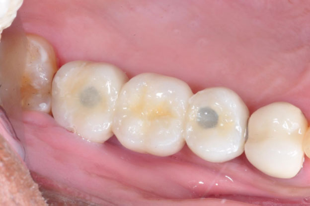 After Dental Implants