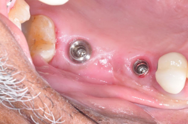Before Dental Implants